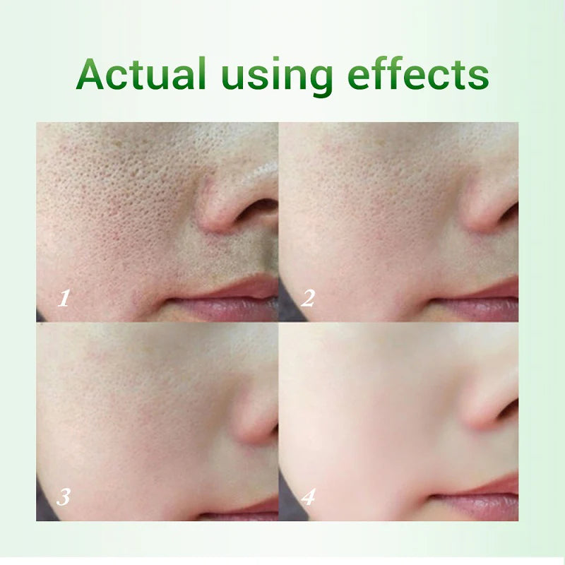 Pore Refining Salicylic Acid Lotion Skin Renewal Cream Beauty Care Essentials